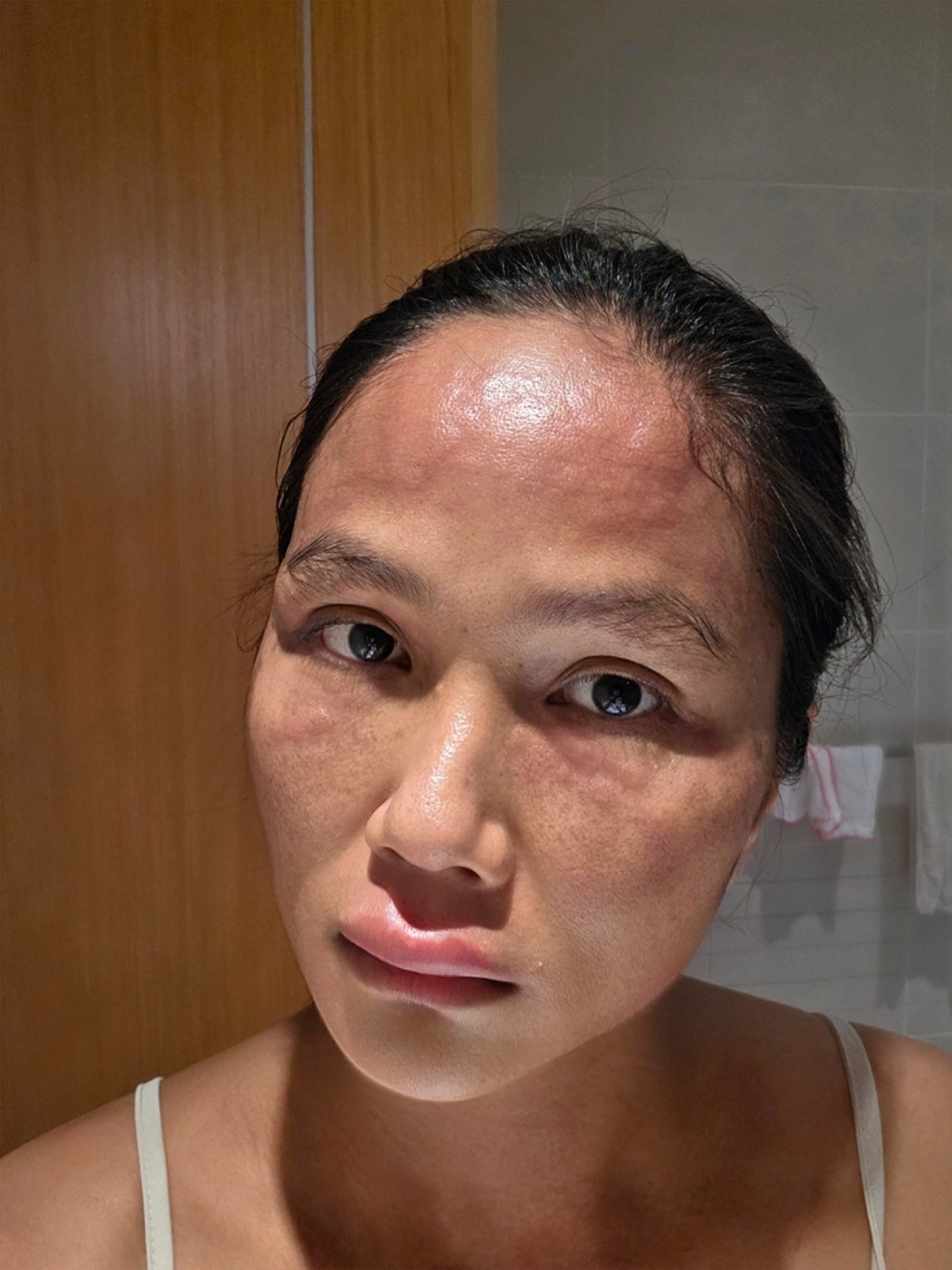 Gương mặt biến dạng sau sinh của H'Hen Niê- Ảnh 1. Gương mặt sưng tấy, ửng đỏ đến biến dạng của H'Hen Niê vì nổi mề đay sau sinh